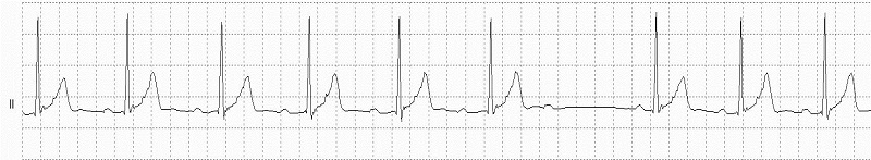 2° AV block Rhythm Strip_fig2